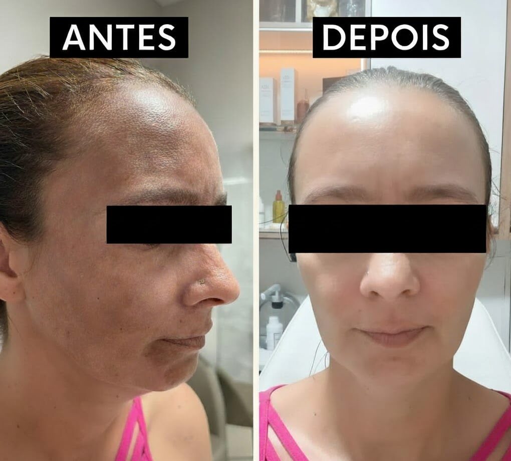 Tratamento melasma em casa antes e depois, protocolo online, pele uniforme e clareamento das manchas sem sair de casa