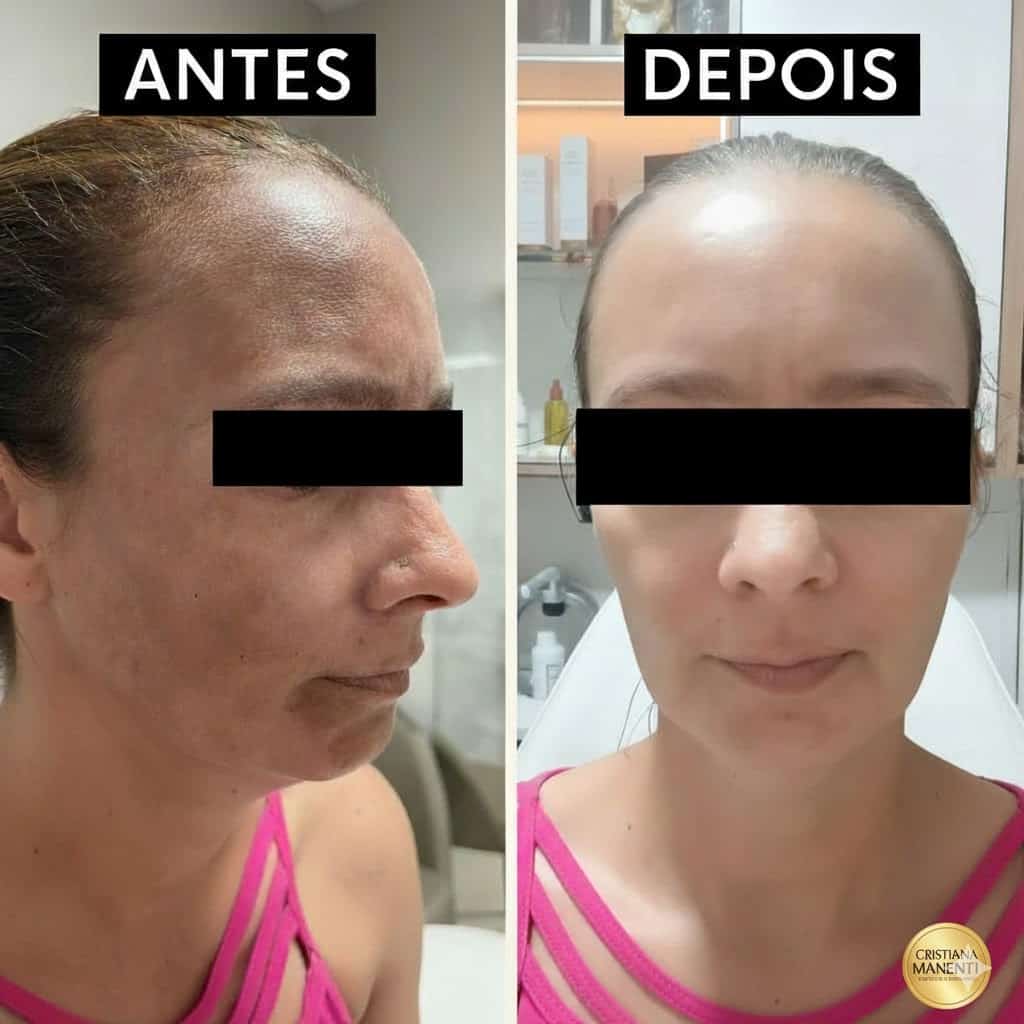 Tratamento melasma em casa antes e depois, protocolo online, pele uniforme e clareamento das manchas sem sair de casa